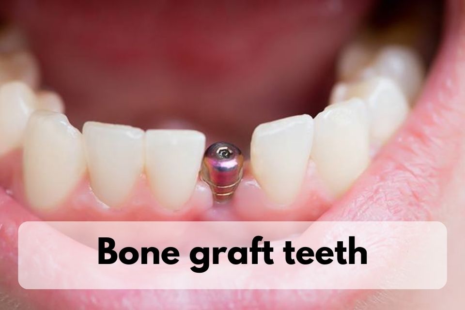 bone graft teeth