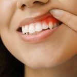 The Ultimate Guide: How to Cure Gum Disease Without a Dentist